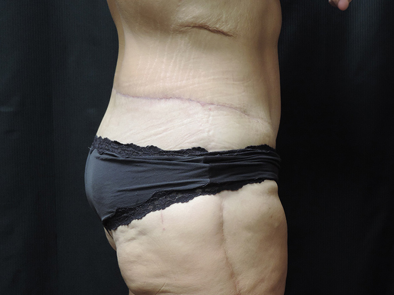 Body Lift Akron Before & After | Patient 01 Photo 3