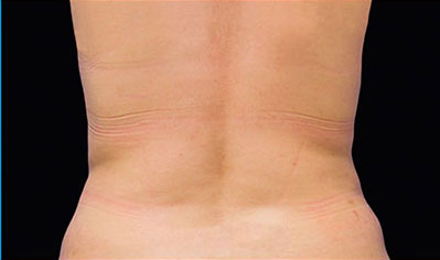 CoolSculpting Akron Before & After | Patient 01 Photo 1