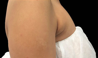 CoolSculpting Akron Before & After | Patient 02 Photo 0