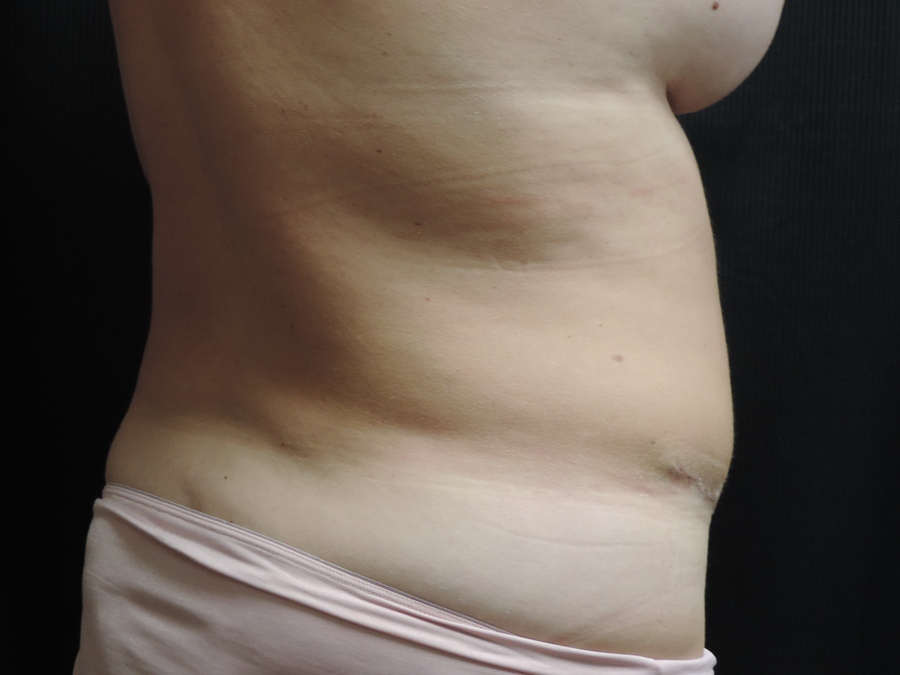 Liposuction Akron Before & After | Patient 01 Photo 3