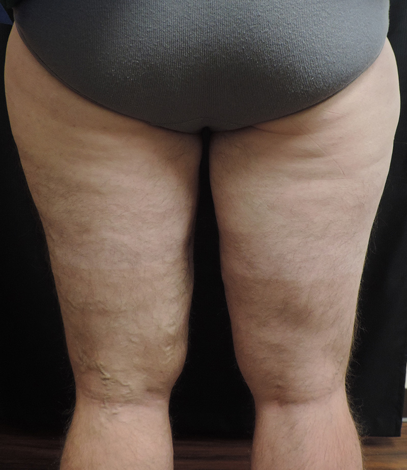 Thigh Lift Akron Before & After | Patient 01 Photo 5