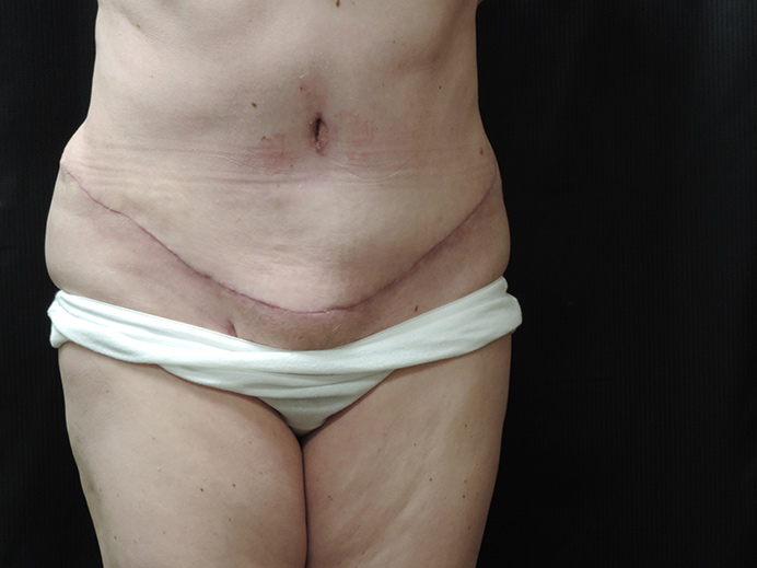 Tummy Tuck Akron Before & After | Patient 02 Photo 1