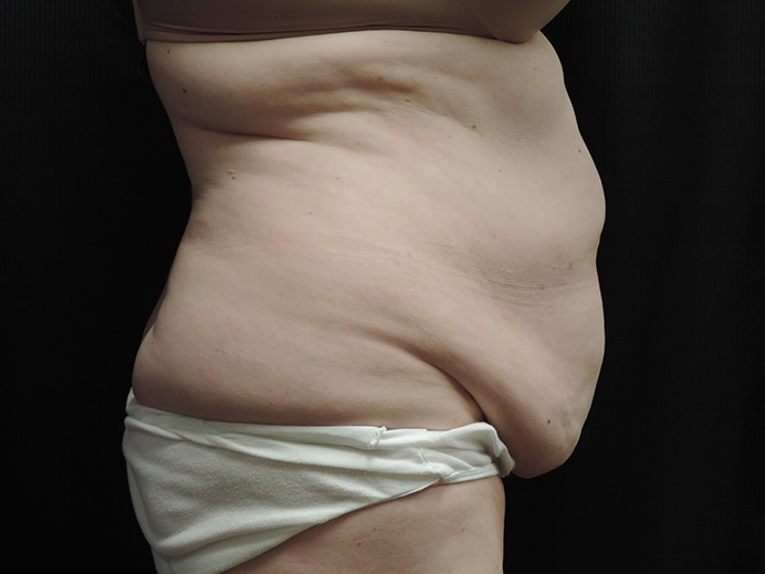 Tummy Tuck Akron Before & After | Patient 02 Photo 2