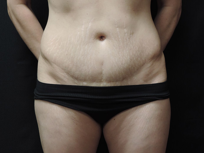 Tummy Tuck Akron Before & After | Patient 03 Photo 0 Thumb
