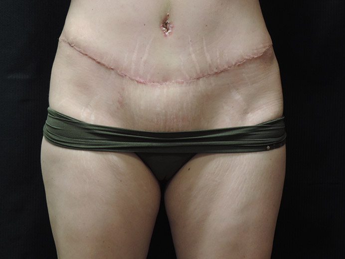 Tummy Tuck Akron Before & After | Patient 03 Photo 1 Thumb