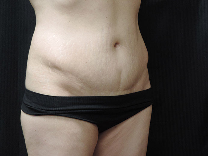 Tummy Tuck Akron Before & After | Patient 03 Photo 2