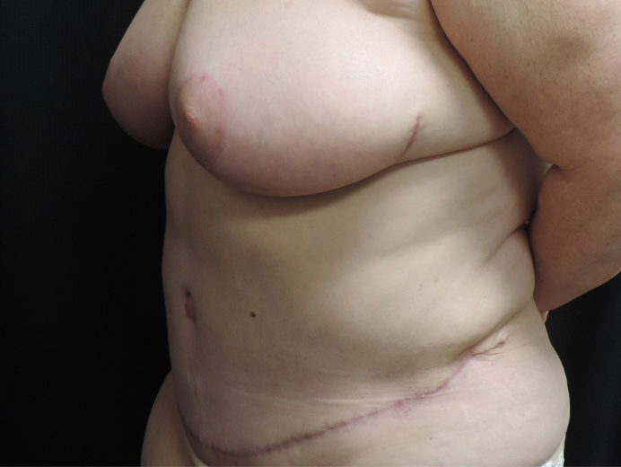 Tummy Tuck Akron Before & After | Patient 04 Photo 7