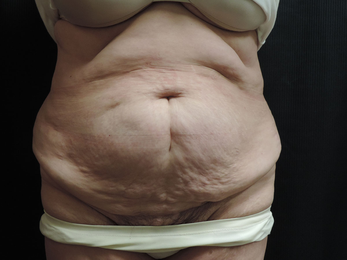 Tummy Tuck Akron Before & After | Patient 06 Photo 0 Thumb