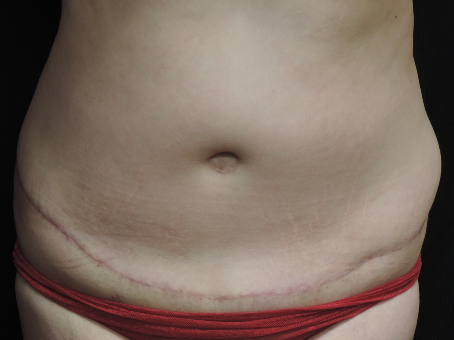 Tummy Tuck Akron Before & After | Patient 08 Photo 1