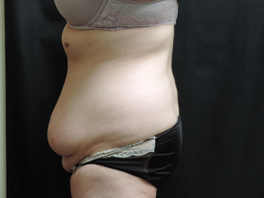 Tummy Tuck Akron Before & After | Patient 08 Photo 2