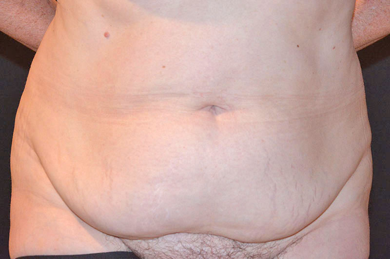 Tummy Tuck Akron Before & After | Patient 10 Photo 0