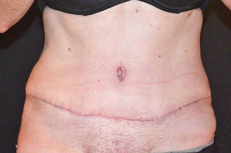 Tummy Tuck Akron Before & After | Patient 10 Photo 1 Thumb