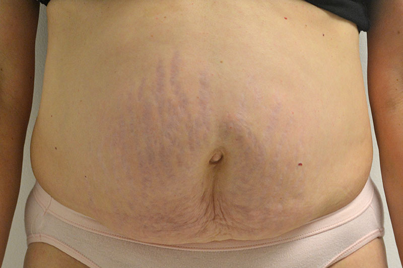 Tummy Tuck Akron Before & After | Patient 11 Photo 0