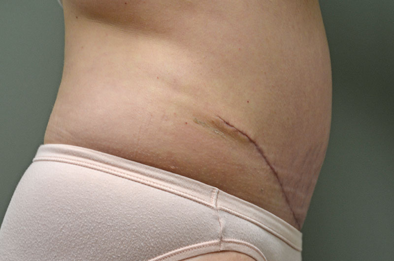 Tummy Tuck Akron Before & After | Patient 11 Photo 3 Thumb