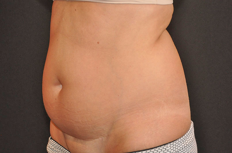 Tummy Tuck Akron Before & After | Patient 12 Photo 2