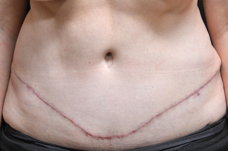 Tummy Tuck Akron Before & After | Patient 13 Photo 1