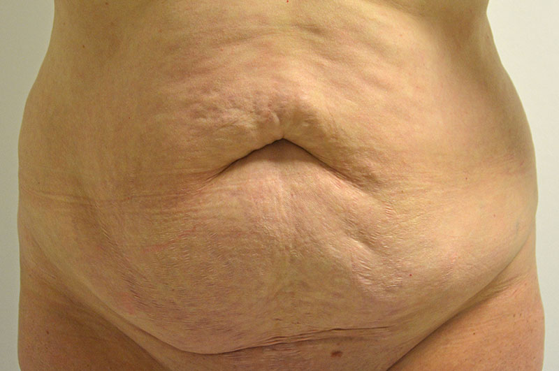 Tummy Tuck Akron Before & After | Patient 14 Photo 0
