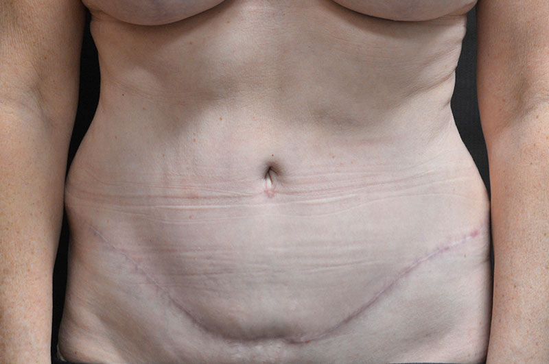 Tummy Tuck Akron Before & After | Patient 14 Photo 1