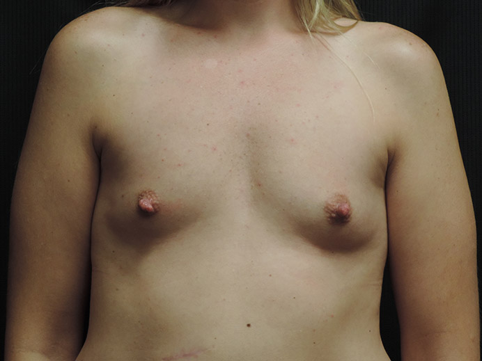 Breast Augmentation Akron Before & After | Patient 02 Photo 0