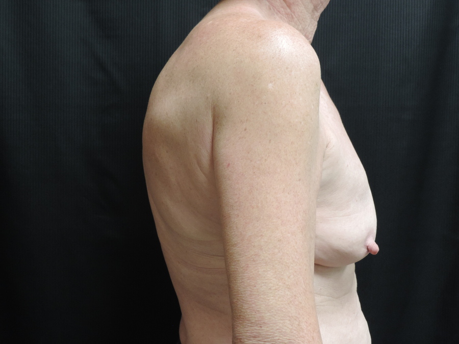 Breast Reconstruction Akron Before & After | Patient 03 Photo 4
