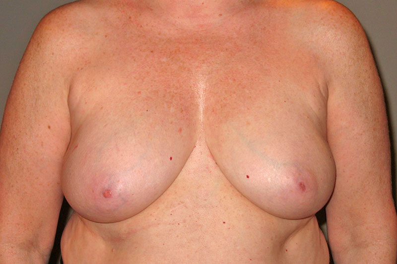 Breast Reconstruction Akron Before & After | Patient 04 Photo 0 Thumb