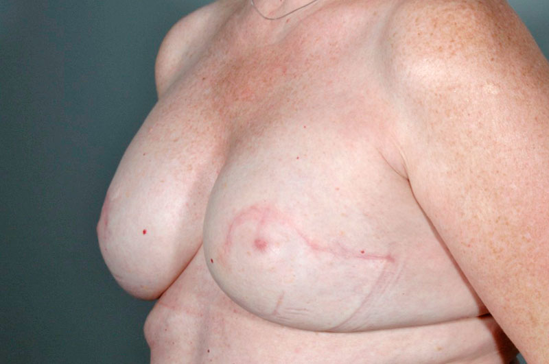 Breast Reconstruction Akron Before & After | Patient 04 Photo 3