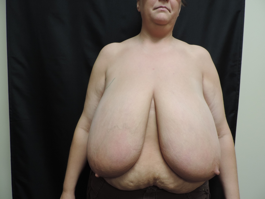 Breast Reduction Akron Before & After | Patient 01 Photo 0