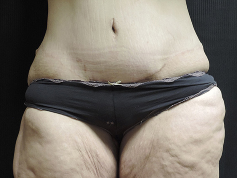 Body Lift Akron Before & After | Patient 01 Photo 0 Thumb