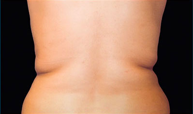 CoolSculpting Akron Before & After | Patient 01 Photo 0 Thumb