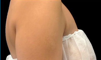 CoolSculpting Akron Before & After | Patient 02 Photo 1 Thumb