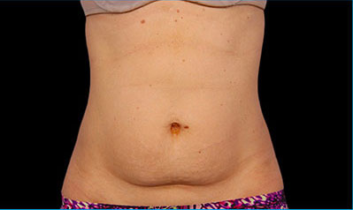 CoolSculpting Akron Before & After | Patient 06 Photo 0 Thumb