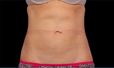 CoolSculpting Akron Before & After | Patient 06 Photo 1