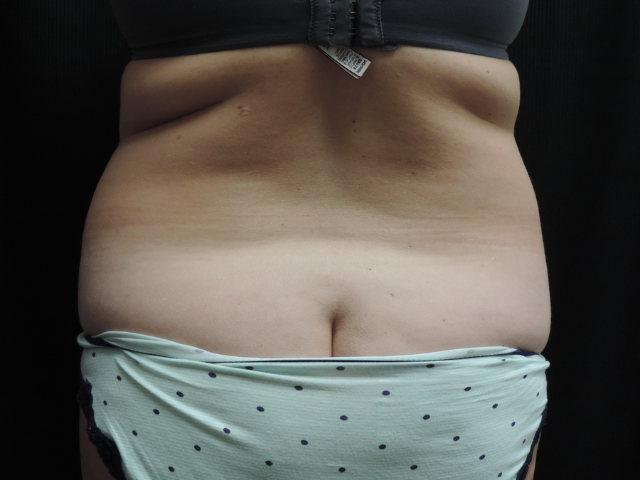 Liposuction Akron Before & After | Patient 01 Photo 0