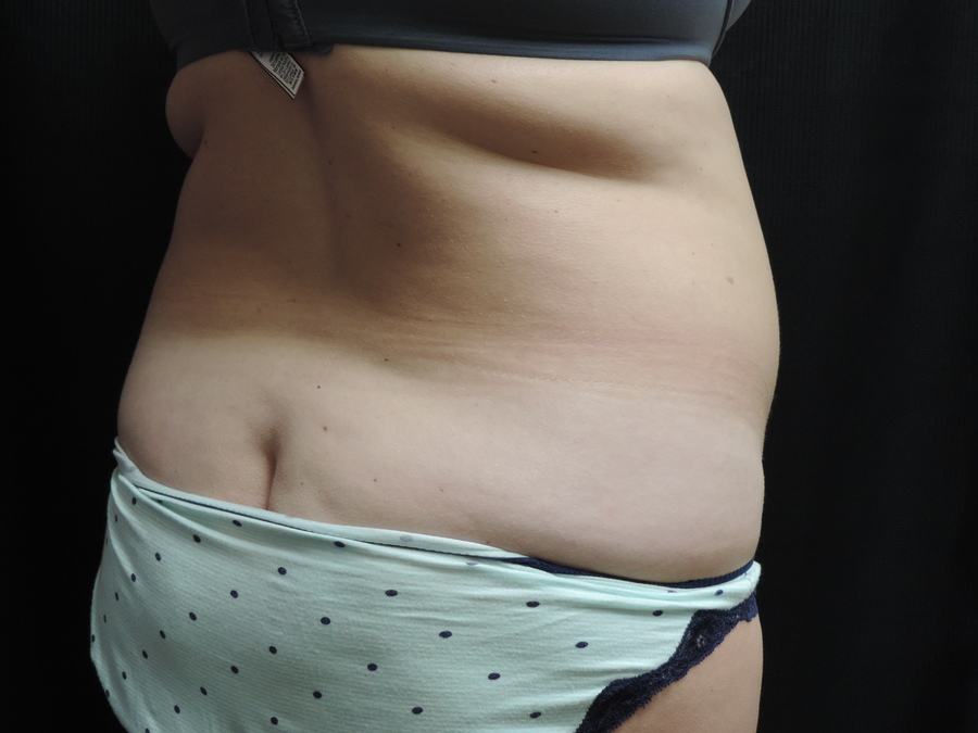 Liposuction Akron Before & After | Patient 01 Photo 2