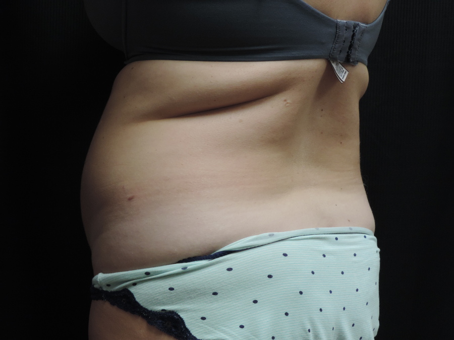Liposuction Akron Before & After | Patient 01 Photo 4 Thumb