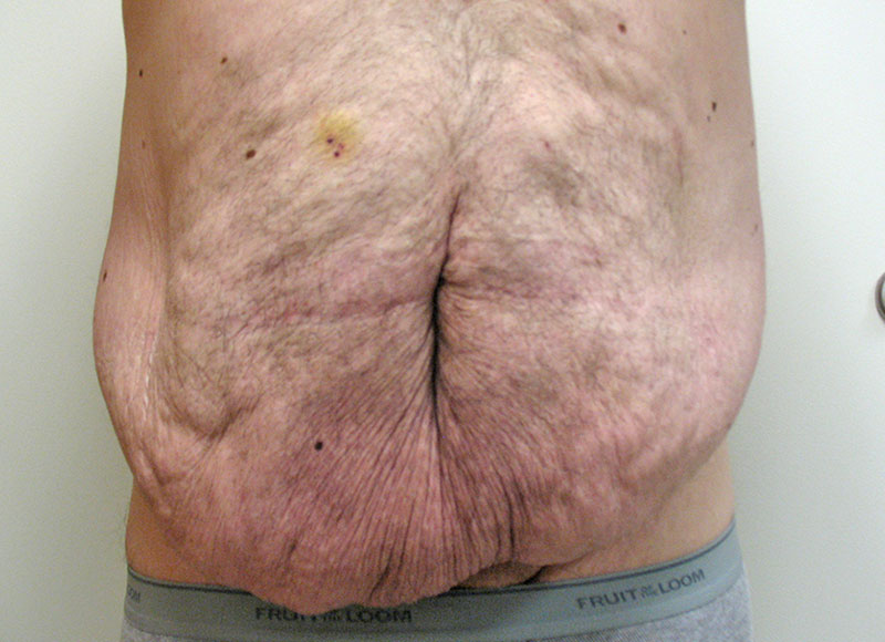 Panniculectomy Akron Before & After | Patient 01 Photo 0 Thumb