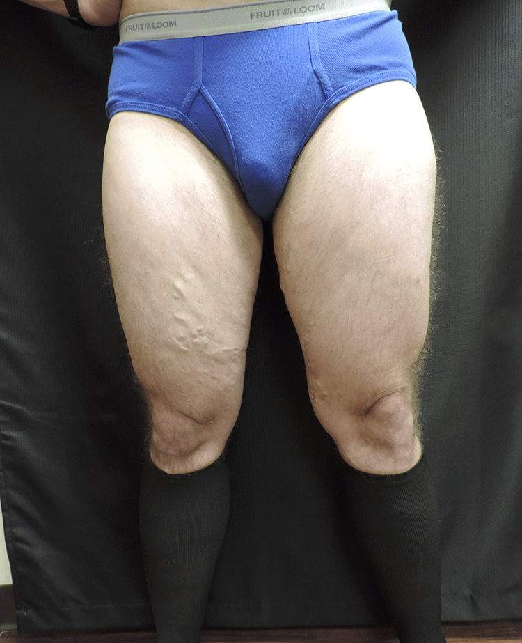 Thigh Lift Akron Before & After | Patient 01 Photo 0 Thumb