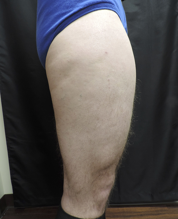 Thigh Lift Akron Before & After | Patient 01 Photo 2 Thumb