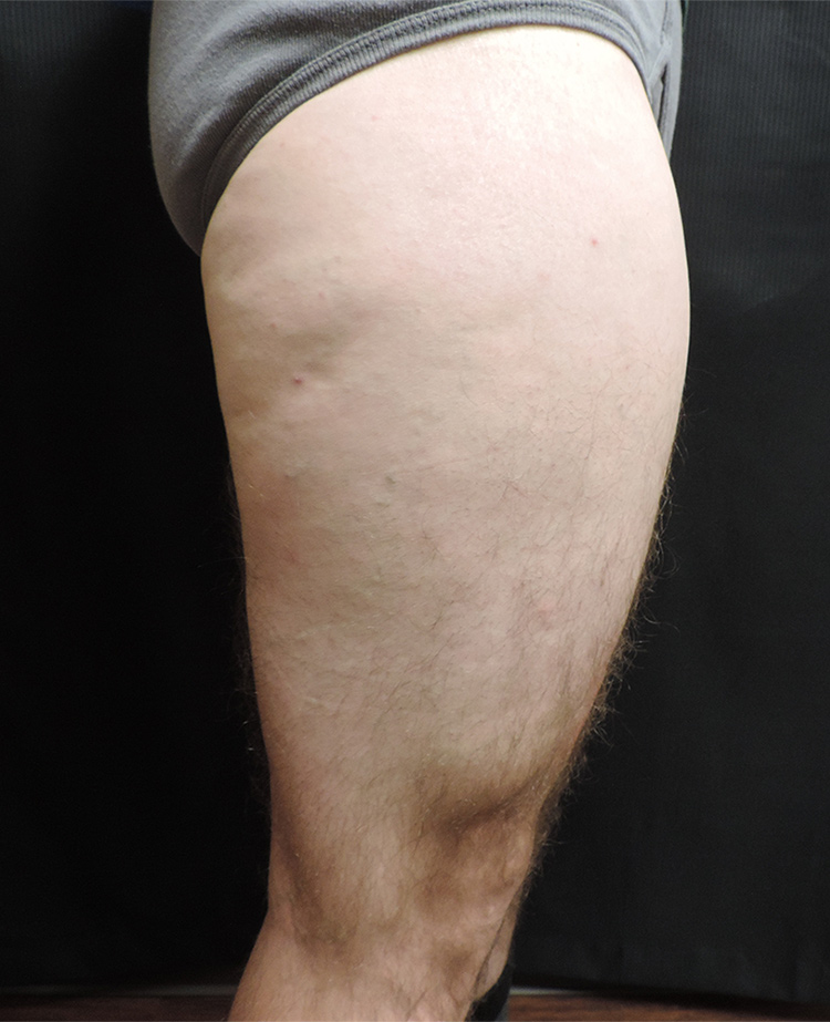 Thigh Lift Akron Before & After | Patient 01 Photo 3