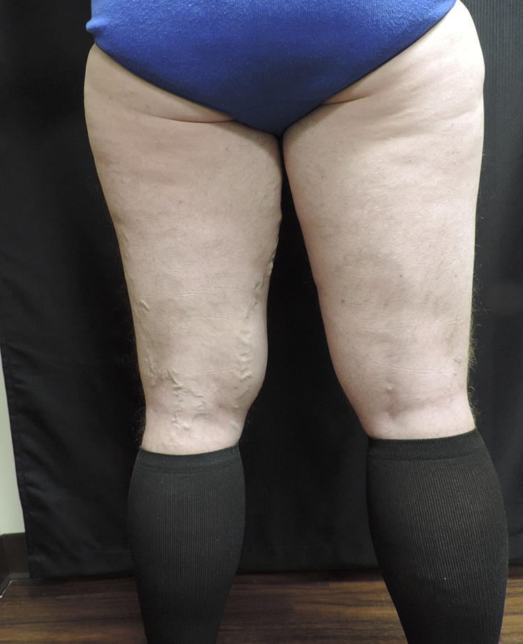 Thigh Lift Akron Before & After | Patient 01 Photo 4