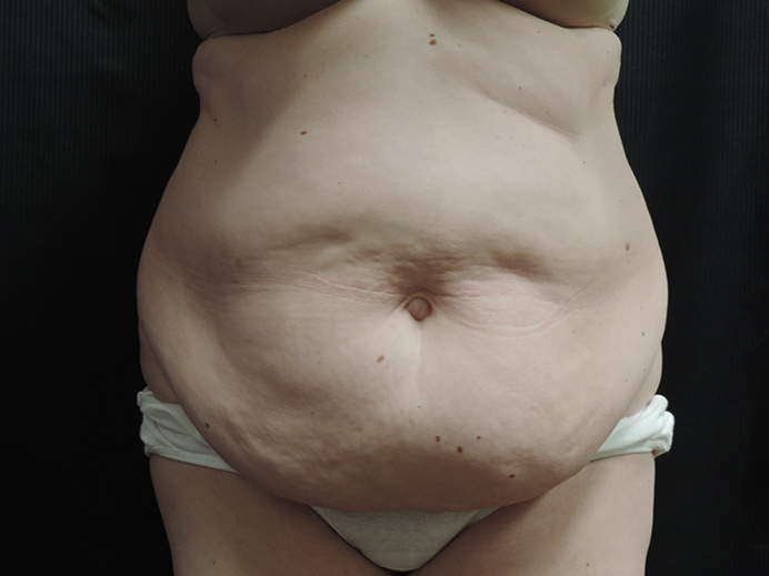 Tummy Tuck Akron Before & After | Patient 02 Photo 0