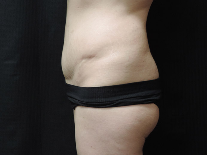 Tummy Tuck Akron Before & After | Patient 03 Photo 4 Thumb