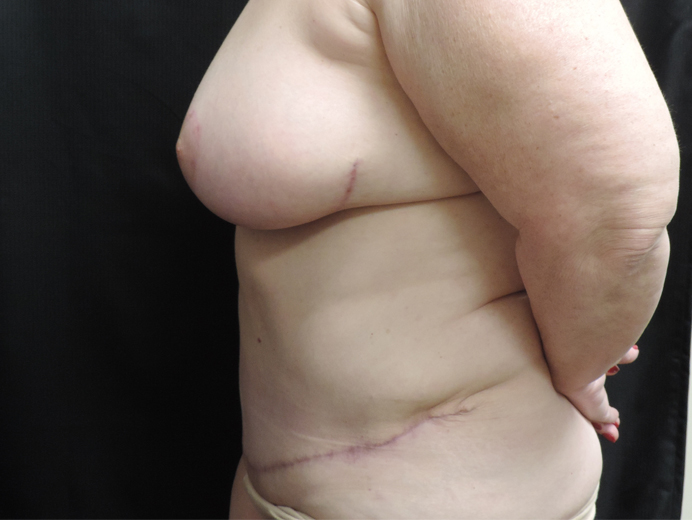 Tummy Tuck Akron Before & After | Patient 04 Photo 9