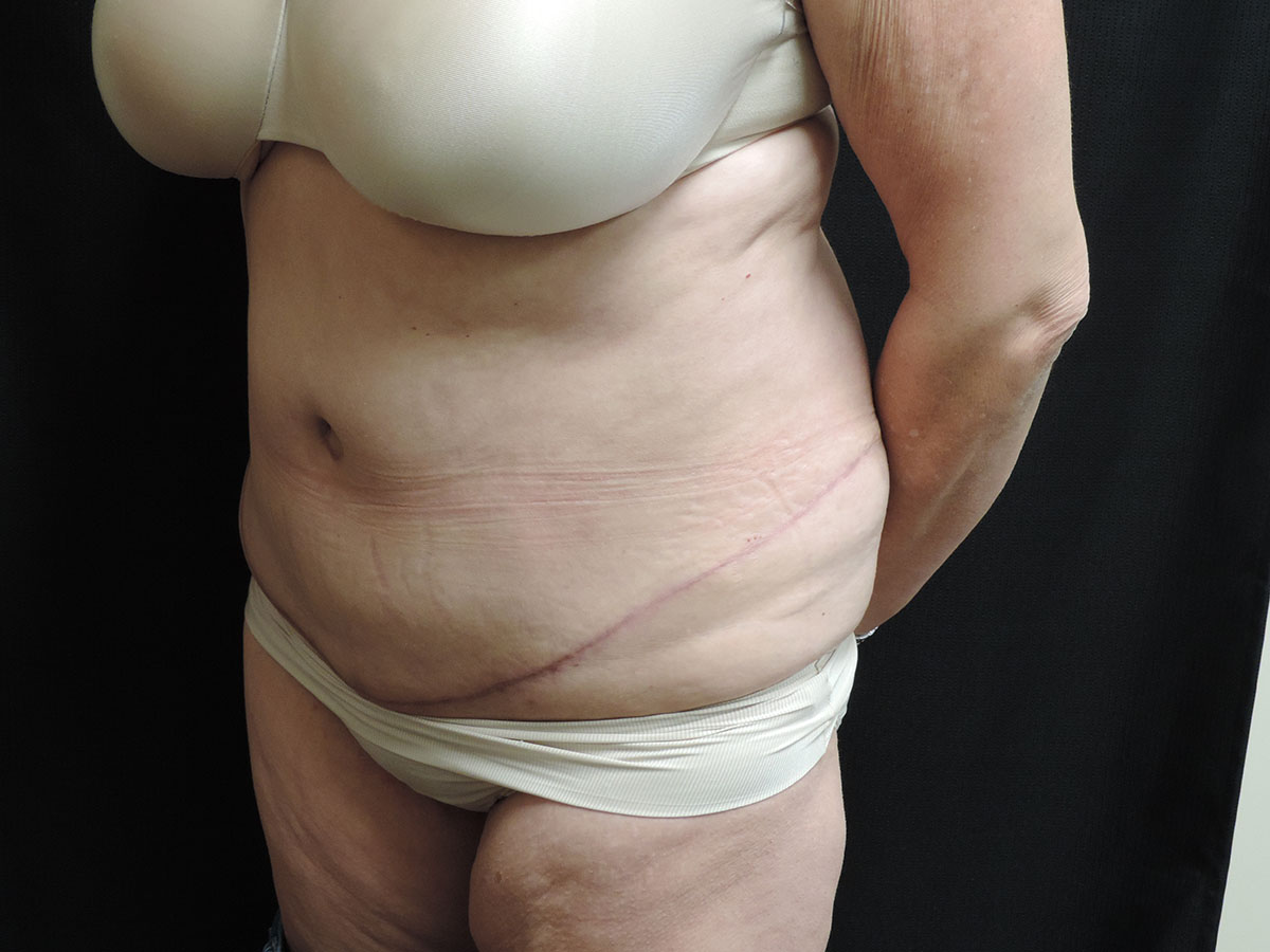 Tummy Tuck Akron Before & After | Patient 06 Photo 3 Thumb