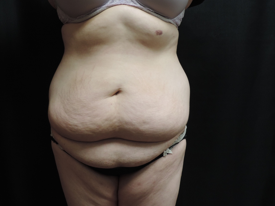 Tummy Tuck Akron Before & After | Patient 08 Photo 0 Thumb