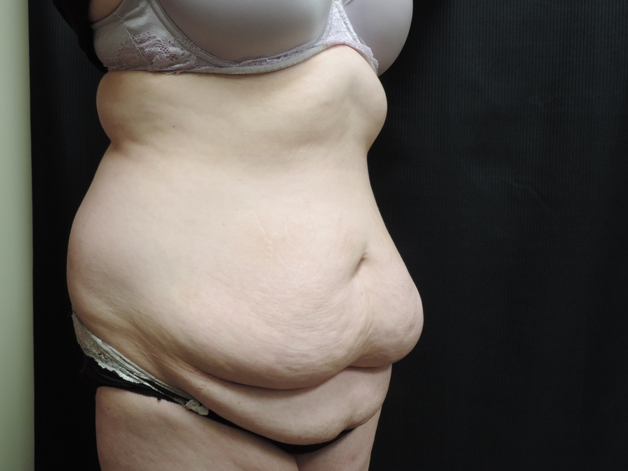 Tummy Tuck Akron Before & After | Patient 08 Photo 4 Thumb
