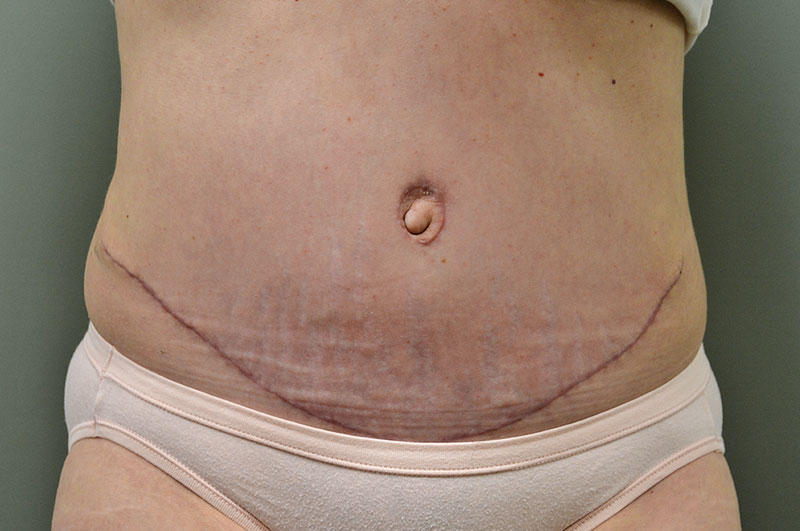 Tummy Tuck Akron Before & After | Patient 11 Photo 1 Thumb
