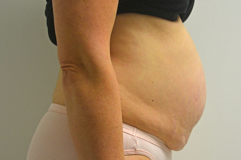 Tummy Tuck Akron Before & After | Patient 11 Photo 2 Thumb