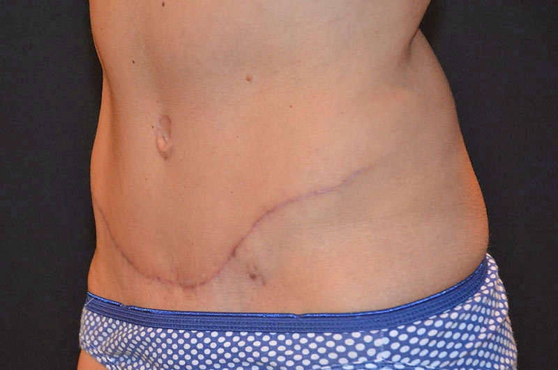 Tummy Tuck Akron Before & After | Patient 12 Photo 3 Thumb