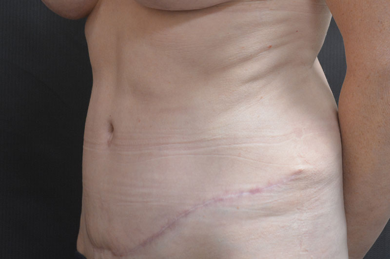 Tummy Tuck Akron Before & After | Patient 14 Photo 3 Thumb